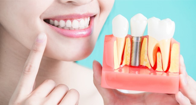 dental implants