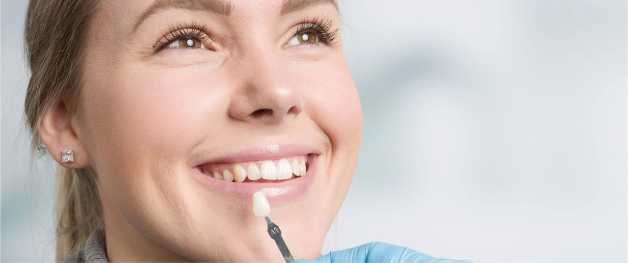 veneers