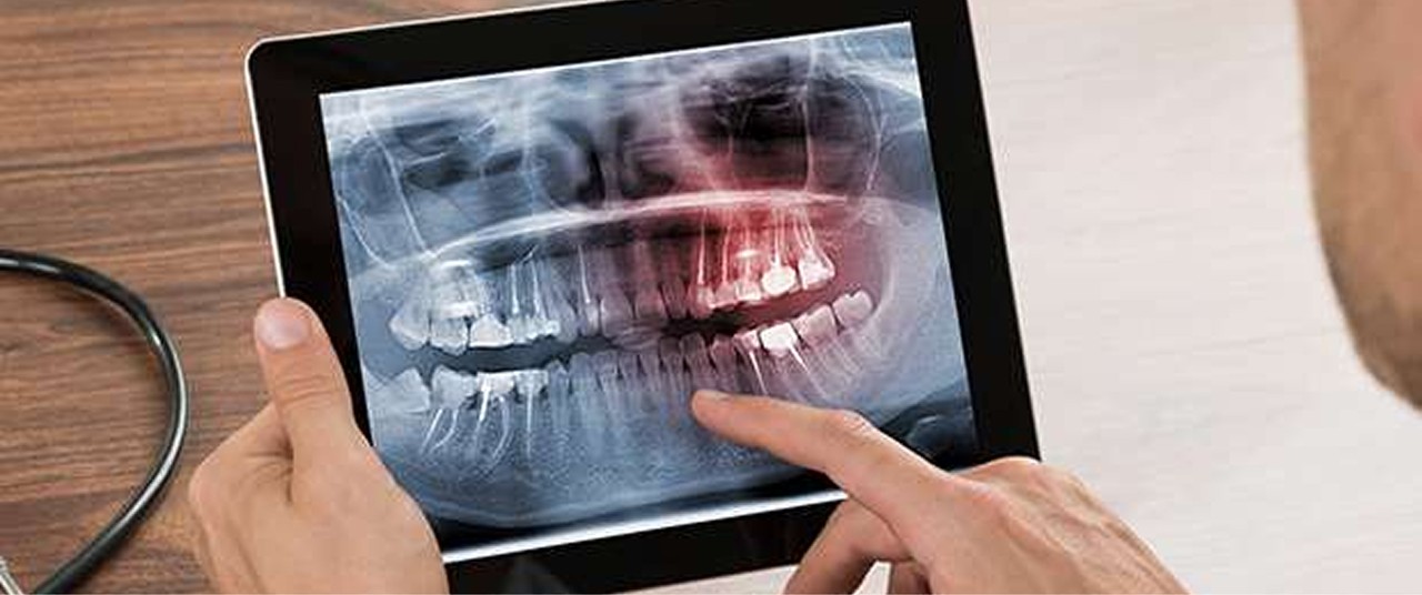 root canals